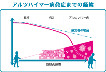 アルツハイマー病発症までの経緯